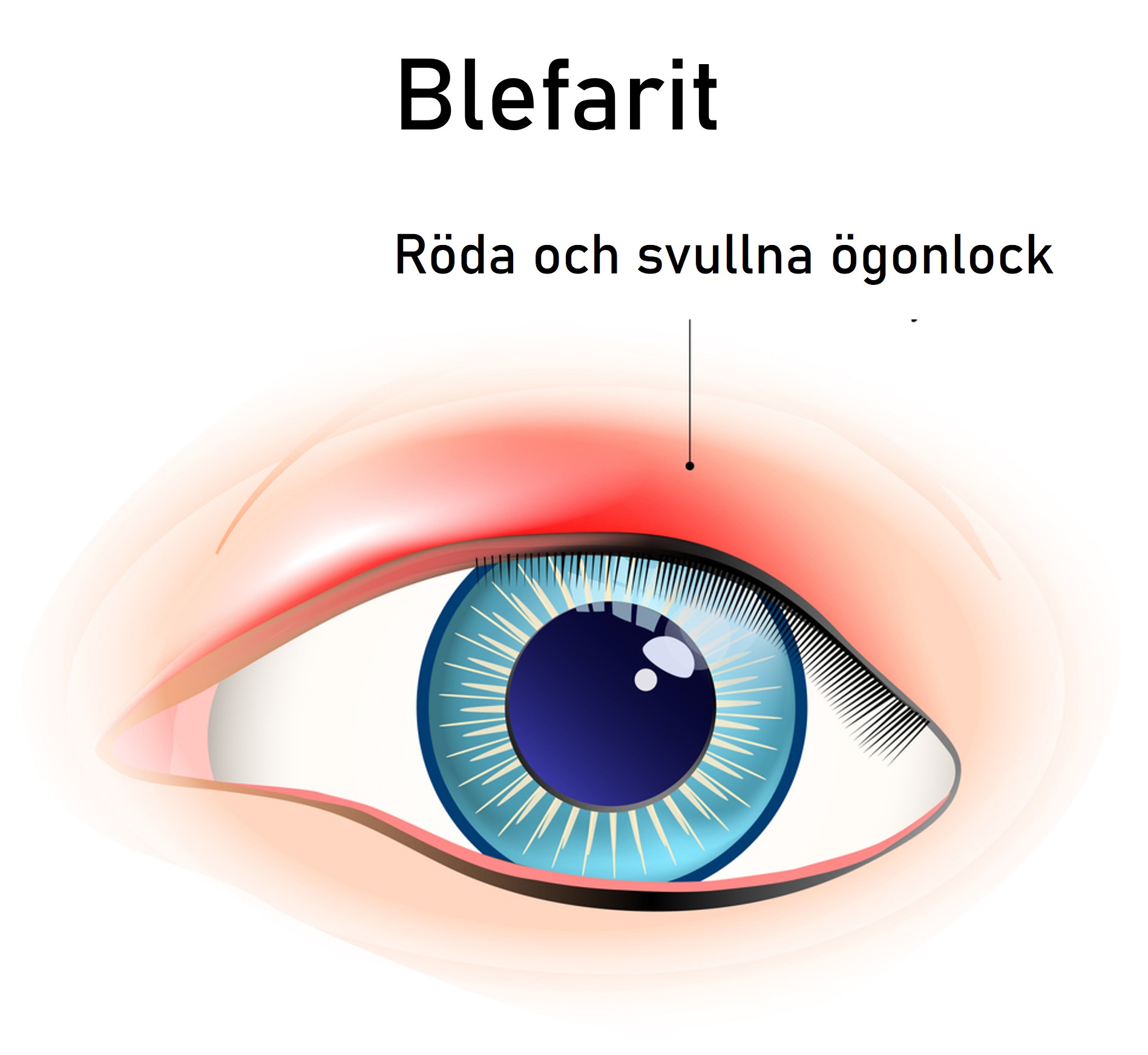Närbild på öga med röd inflammation